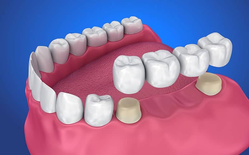 dental-bridges-in-aspen-sw-calgary Dental Bridges in Aspen, SW Calgary