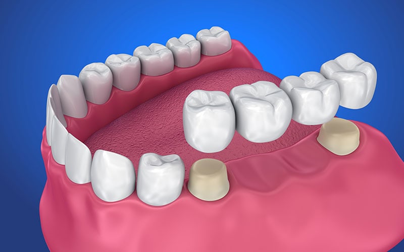 Denture Bridges in Aspen