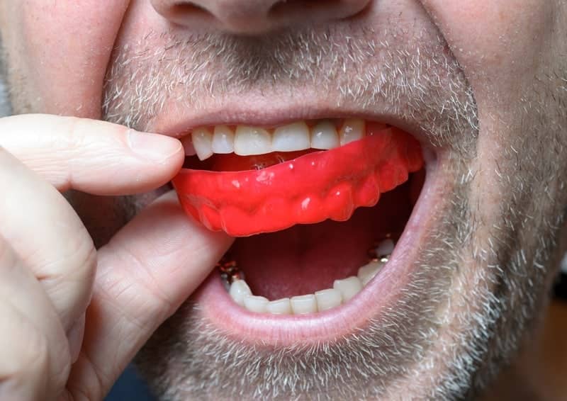 Mouth Guards in Aspen, SW Calgary