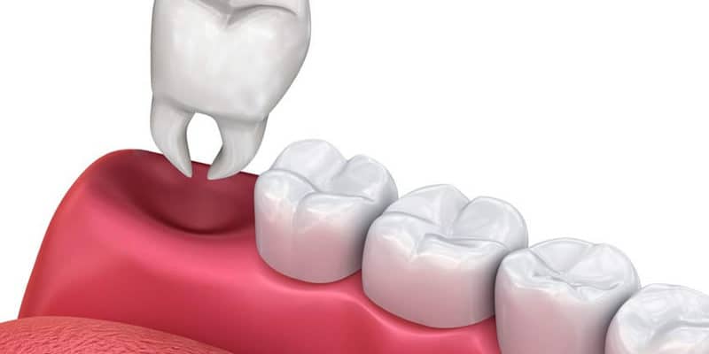 Wisdom Teeth Extractions in Aspen, SW Calgary