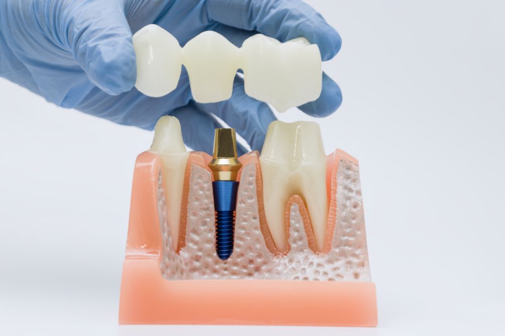 Can a Dental Bridge Fix a Missing Tooth Permanently?